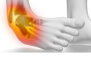 What's the Difference Between Sprains and Strains? | Peak Performance Physical Therapy