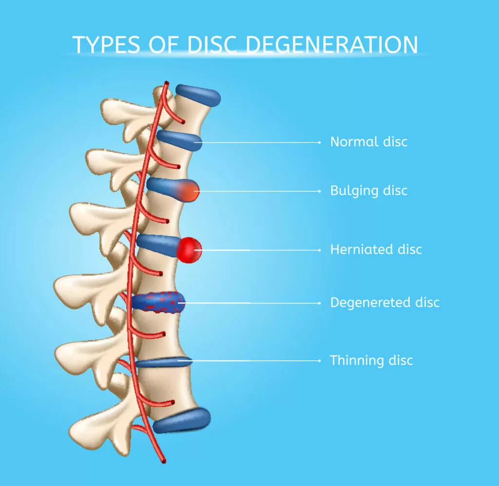 Herniated Discs Can Be a Real Pain in the Back - Are You Living with One?