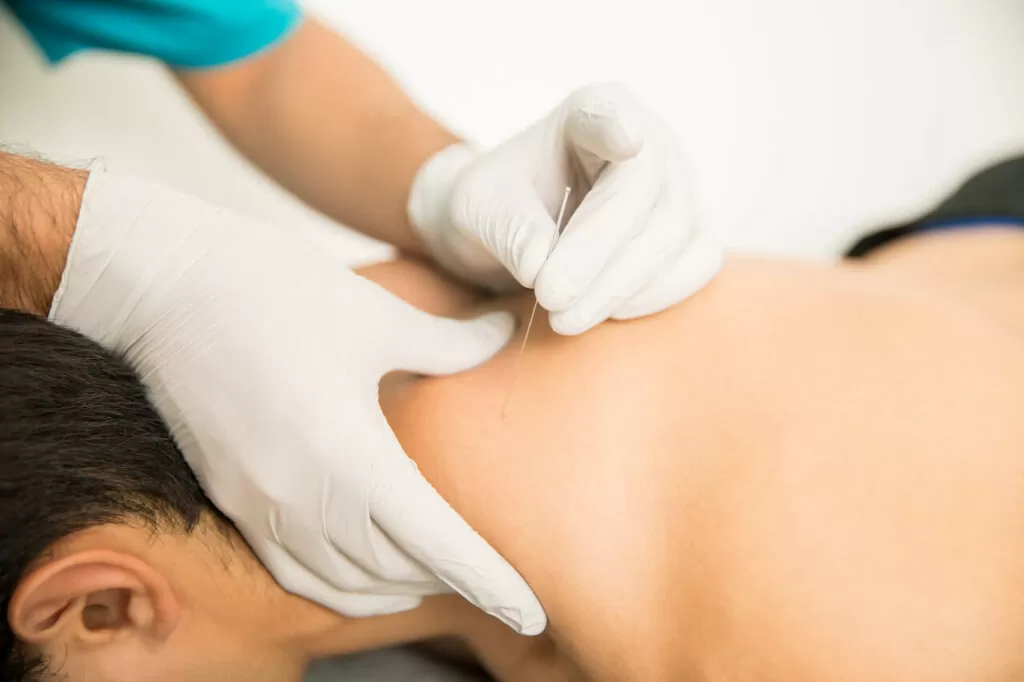 How Can Dry Needling Benefit Me?